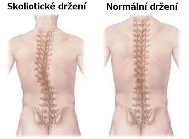 Záda zezadu s vyznačenou páteří — skoliotické zakřivení vlevo, normální rovná páteř vpravo